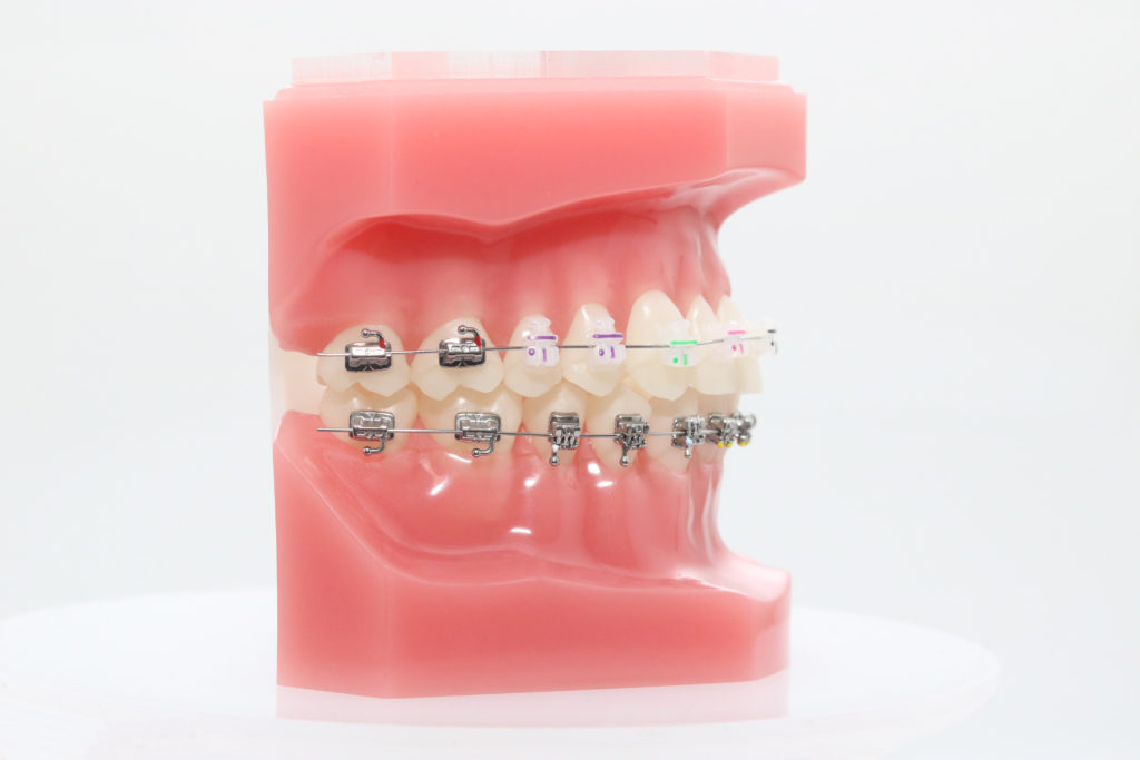 Clear 21™ SL Keramik Bracket Greiner Orthodontics